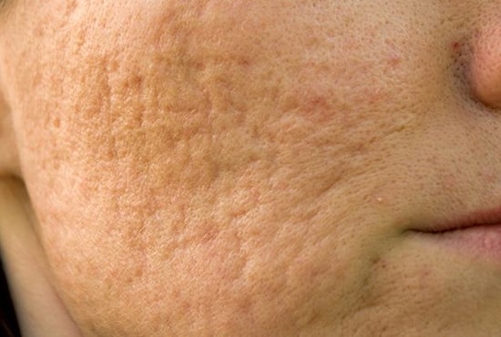 acne scar treatment in Dubai