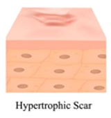 scar above skin level