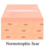 scar at skin level