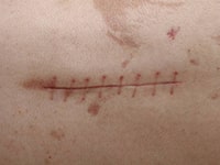 shape disorders scar