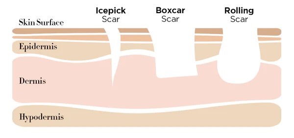 type of acne scars