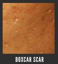 boxcar acne scar