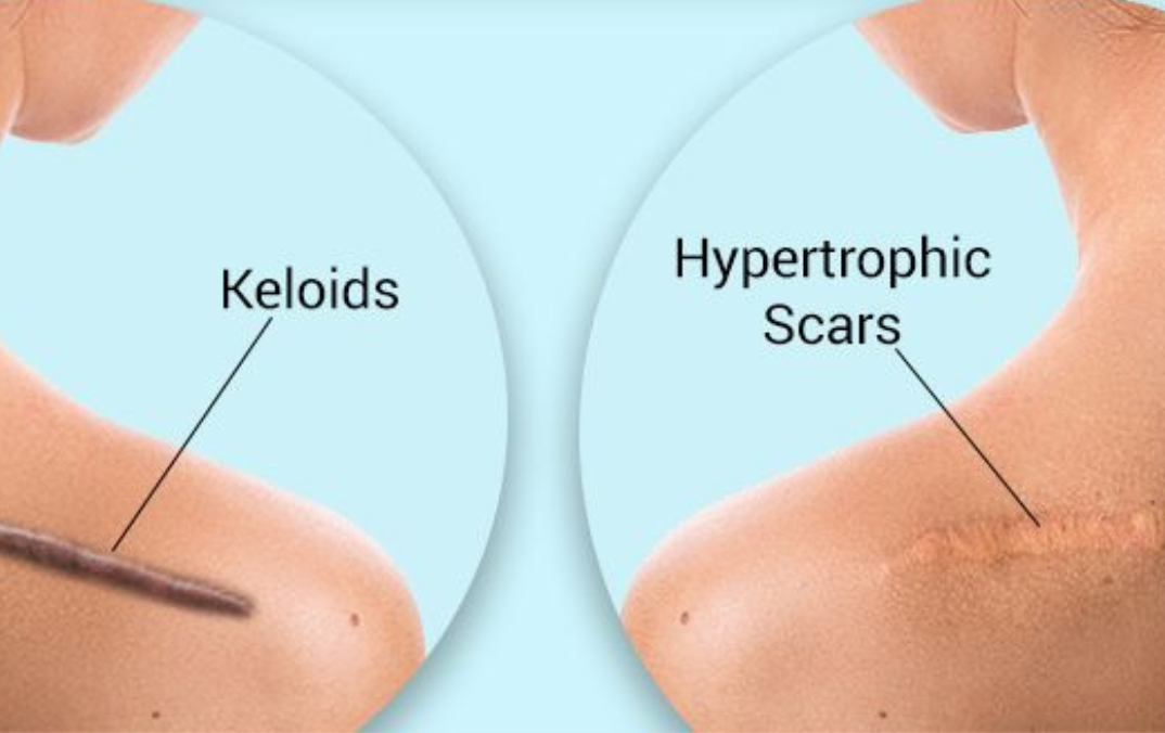 hypertrophic scar vs keloid